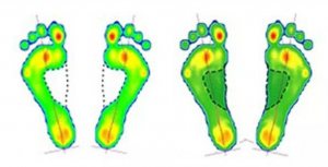 Flat Feet