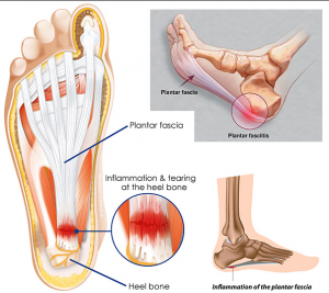 plantar fasciitis