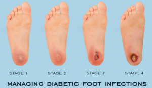 Prevenire i piedi diabetici