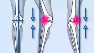 Semelles orthopédiques genou Varus