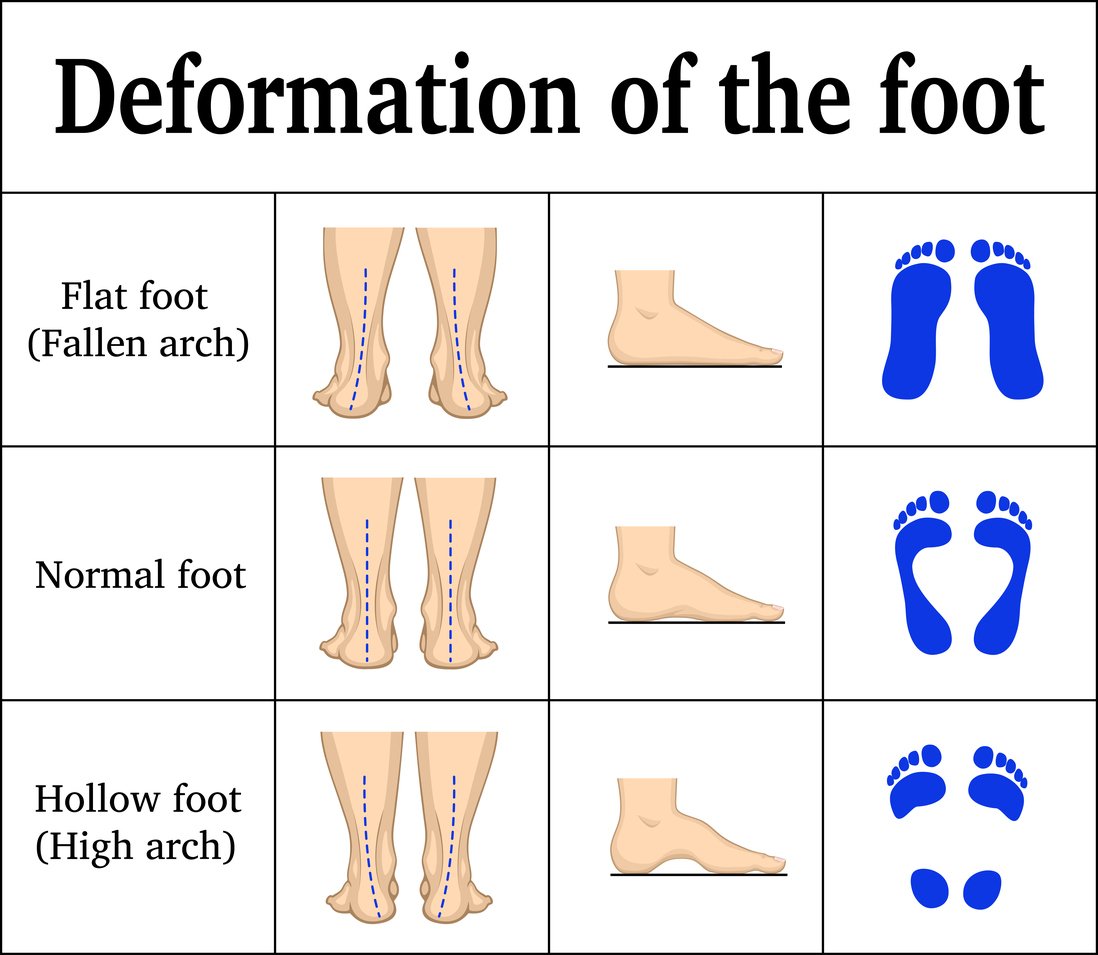 deformation of the feet