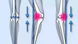 Knee Varus Orthotic Insoles