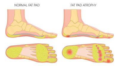 Syndrome du coussinet du talon