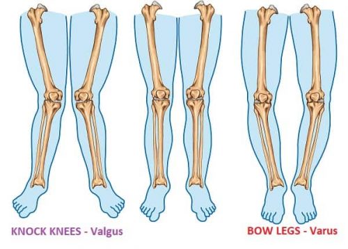 Knee Varus - Definition & Causes | Ideastep
