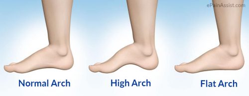 high arch feet