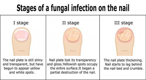 Toenail fungus