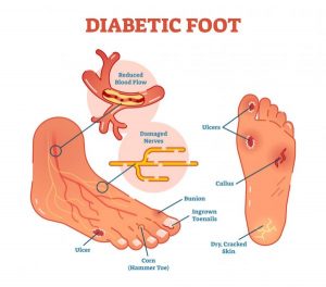 Diabetischer Fuß medizinisch