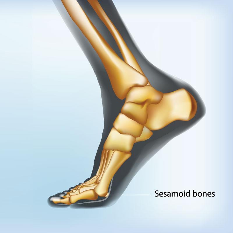 sesamoiditis