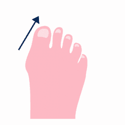 10 Step Guide for Treating Bunion Pain