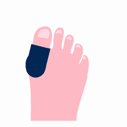 10 Step Guide for Treating Bunion Pain