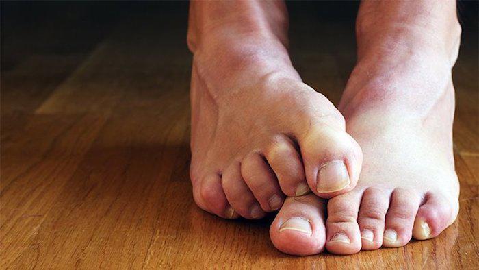 Orthotics for Hammertoe: Can They Help?