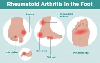 Arthritis Foot