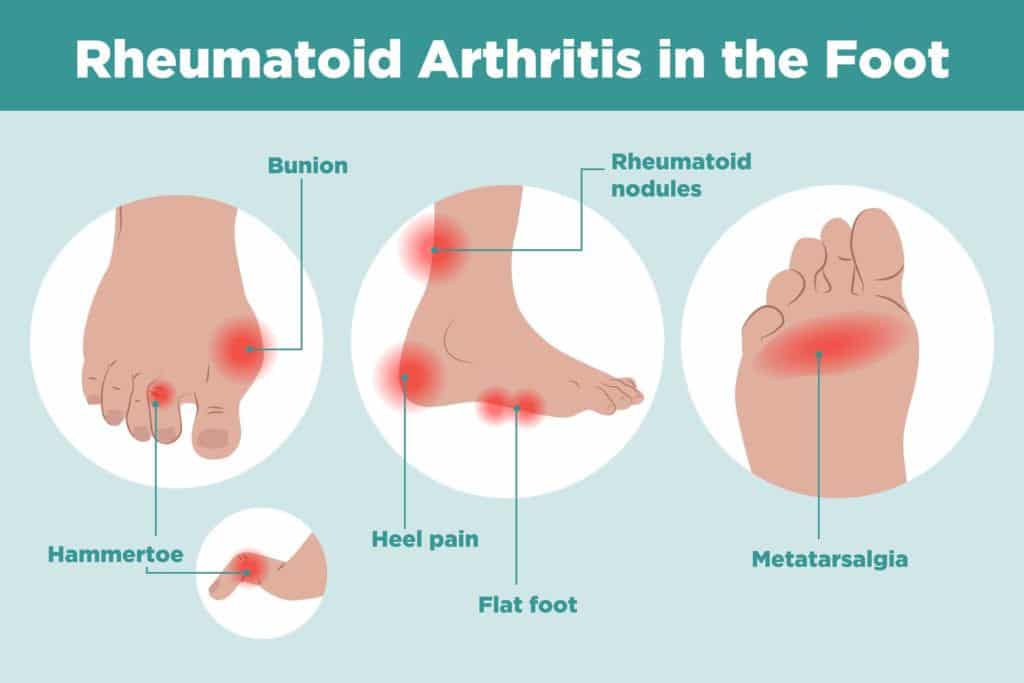 Arthritis Foot