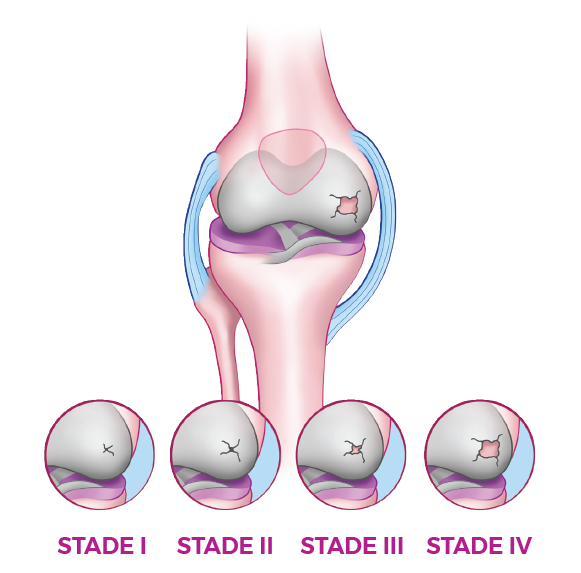 the insoles for osteoarthritis of the knee