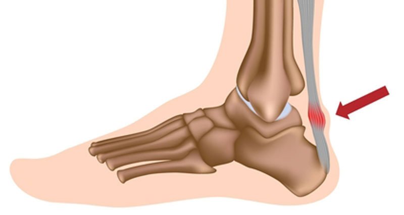 Heel Inserts for Achilles Tendonitis