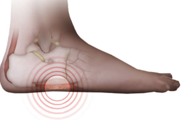 a lateral heel wedge for medial knee pain