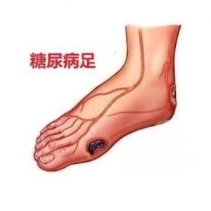 Complications of diabetes foot 