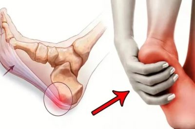 the causes of plantar fasciitis