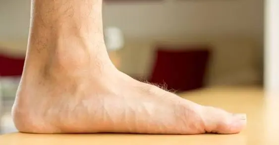 flat feet